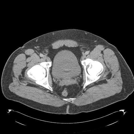 File:Adrenal cyst (Radiopaedia 45625-49776 Axial C+ portal venous phase 93).png