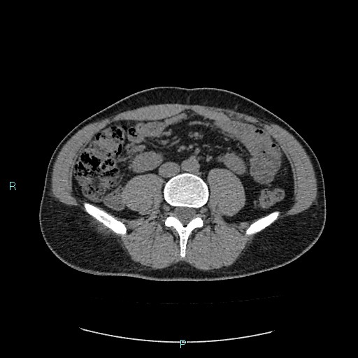 Adrenal cystic lymphangioma (Radiopaedia 83161-97534 Axial non-contrast 58).jpg