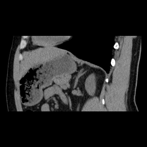 Adrenal gland trauma (Radiopaedia 81351-95079 Sagittal non-contrast 64).jpg