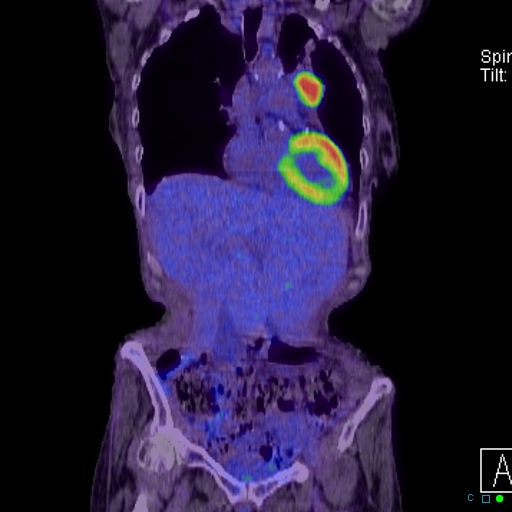 File:Adrenal metastasis from small cell lung cancer (Radiopaedia 19133-19109 Coronal 7).jpg