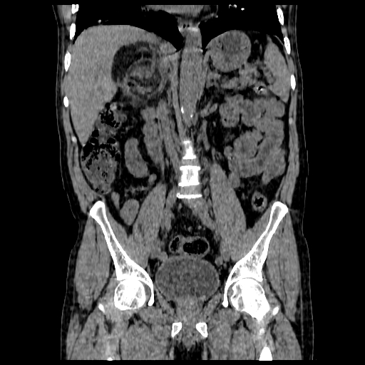 File:Adrenal myelolipoma (Radiopaedia 41843-44834 Coronal non-contrast 5).jpg