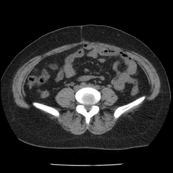 Adrenal myelolipoma (Radiopaedia 43401-46759 Axial non-contrast 55).jpg