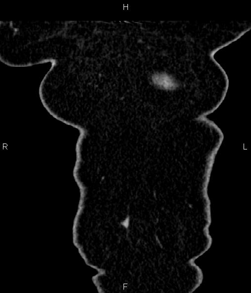 Adrenal myelolipoma (Radiopaedia 82742-96986 Coronal renal cortical phase 6).jpg
