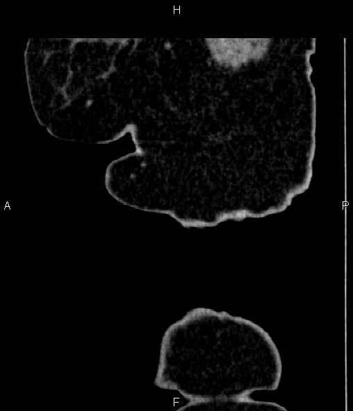 Adrenal myelolipoma (Radiopaedia 82742-96986 Sagittal renal cortical phase 4).jpg
