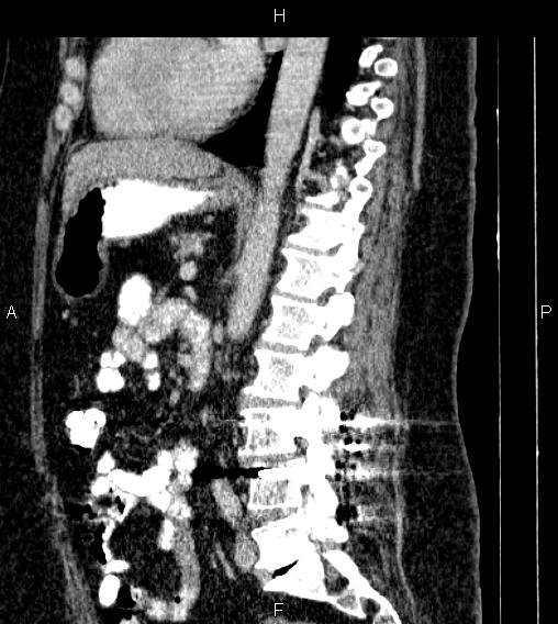 Adrenal myelolipoma (Radiopaedia 84319-99617 Sagittal renal cortical phase 54).jpg