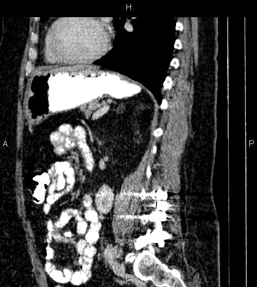 Adrenal myelolipoma (Radiopaedia 84319-99617 Sagittal renal cortical phase 60).jpg