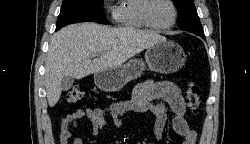 Adrenal myelolipoma (Radiopaedia 84321-99619 Coronal non-contrast 23).jpg