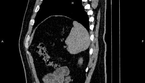 Adrenal myelolipoma (Radiopaedia 84321-99619 Sagittal non-contrast 92).jpg