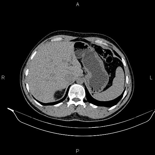 File:Adrenal myelolipoma (Radiopaedia 87794-104246 Axial non-contrast 23).jpg