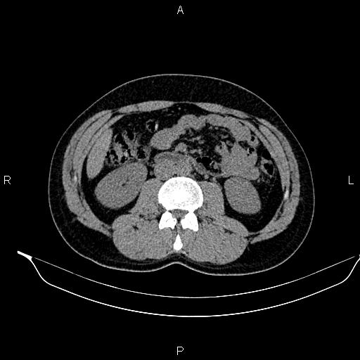 Adrenal myelolipoma (Radiopaedia 87794-104246 Axial non-contrast 53).jpg