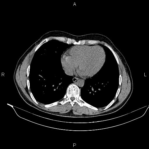 Adrenal myelolipoma (Radiopaedia 87794-104246 Axial non-contrast 6).jpg