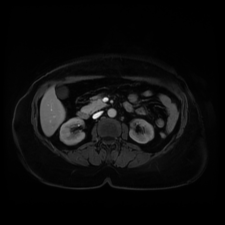 Adrenal myelolipoma - MRI (Radiopaedia 83249-97646 T1 fat sat arterial phase 48).jpg