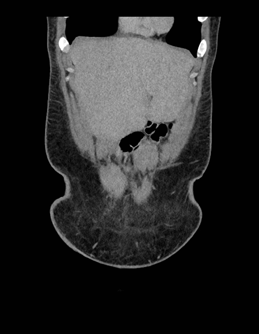 Adrenal myelolipoma - bilateral (Radiopaedia 74805-85810 Coronal C+ portal venous phase 228).jpg