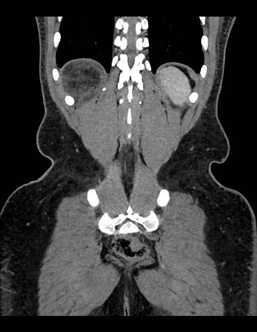 Adrenal myelolipoma - bilateral (Radiopaedia 74805-85810 Coronal C+ portal venous phase 72).jpg