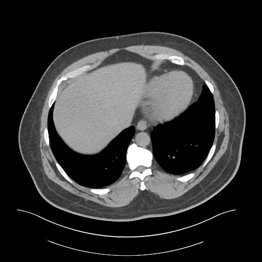 File:Adrenal vein sampling and adrenal nodular hyperplasia - Conn syndrome (Radiopaedia 30561-31337 Axial non-contrast 2).jpg