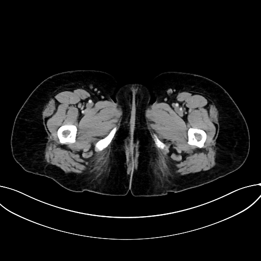 Adrenocortical carcinoma (Radiopaedia 87281-103569 Axial C+ portal venous phase 95).jpg