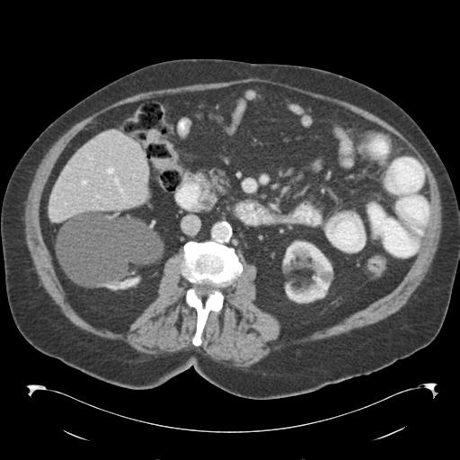 Adult ileal intussusception with secondary obstruction (Radiopaedia 30395-31051 Axial C+ portal venous phase 35).jpg