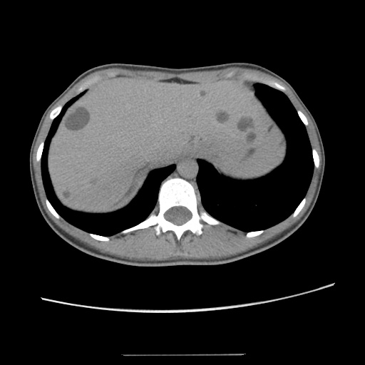 File:Adult polycystic kidney disease (Radiopaedia 48845-53876 Axial renal excretory phase 22).jpg
