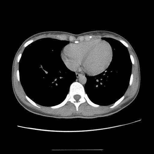 Adult polycystic kidney disease (Radiopaedia 48845-53876 Axial renal excretory phase 6).jpg