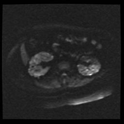 Adult polycystic kidney disease (Radiopaedia 59075-66365 Axial DWI 45).jpg