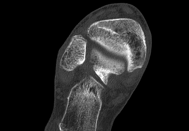 Advanced osteomyelitis due to open metatarsal fracture (Radiopaedia 83891-99095 Axial bone window 3).jpg