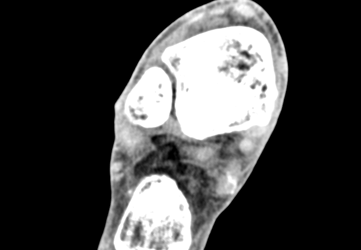 Advanced osteomyelitis due to open metatarsal fracture (Radiopaedia 83891-99095 Axial non-contrast 1).jpg
