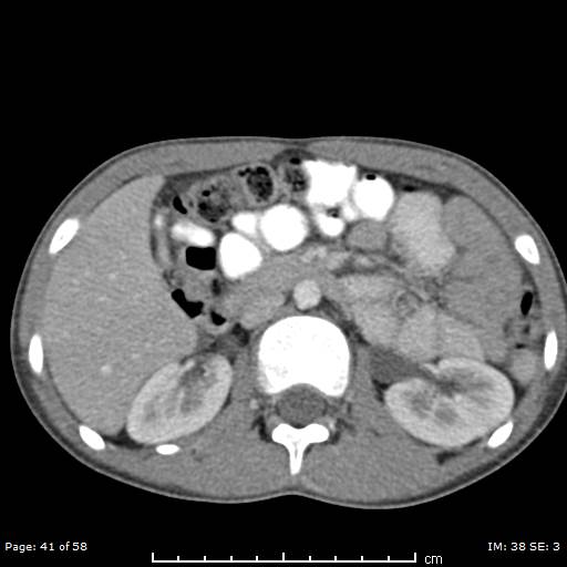Agenesis of the gallbladder (Radiopaedia 55454-61905 B 41).jpg