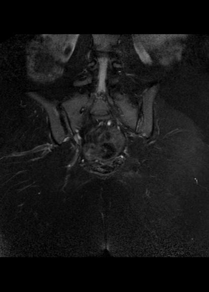 File:Aggressive angiomyxoma of the pelvis and perineum (Radiopaedia 59162-66479 Coronal T2 fat sat 23).jpg