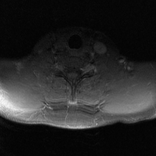 File:Aggressive vertebral hemangioma (Radiopaedia 39937-42404 Axial T1 C+ fat sat 42).png