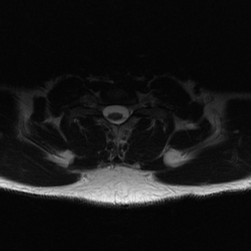 File:Aggressive vertebral hemangioma (Radiopaedia 39937-42404 Axial T2 41).png