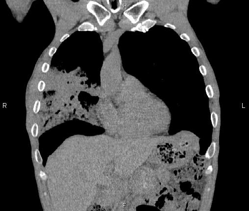 Air bronchogram in pneumonia (Radiopaedia 85719-101512 Coronal non-contrast 17).jpg