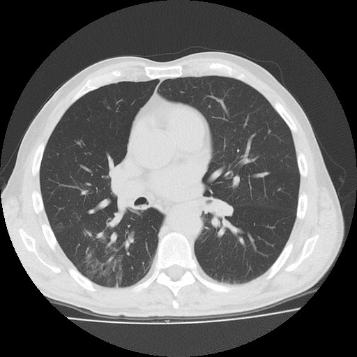 File:Allergic bronchopulmonary aspergillosis (ABPA) (Radiopaedia 60594-68313 Axial lung window 31).jpg
