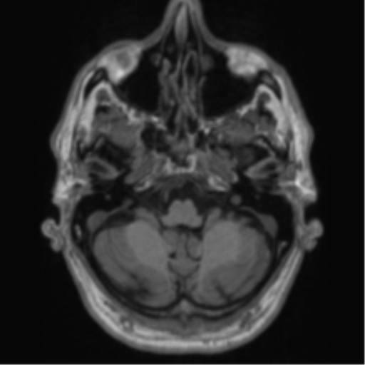 Alzheimer's disease- with Gerstmann syndrome and dressing apraxia (Radiopaedia 54882-61150 Axial T1 14).png