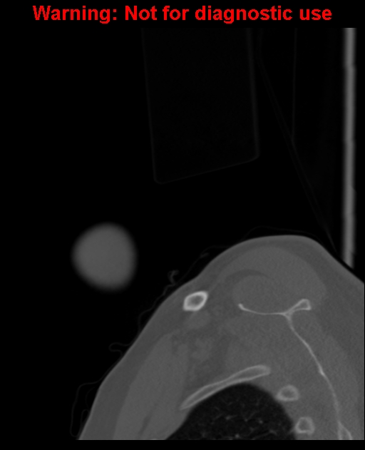 Ameloblastoma (Radiopaedia 33126-34164 Sagittal bone window 6).jpg