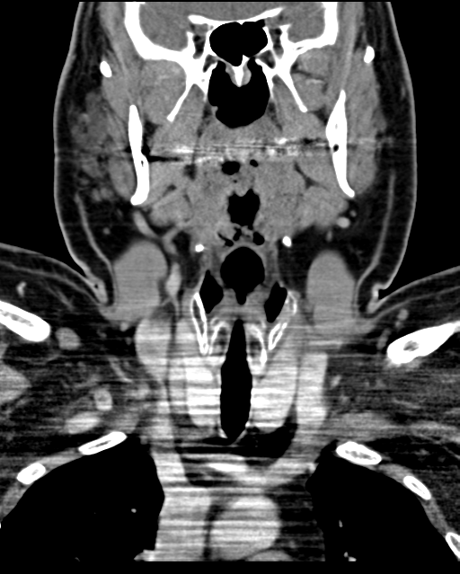 Ameloblastoma (Radiopaedia 38520-40623 Coronal non-contrast 36).png