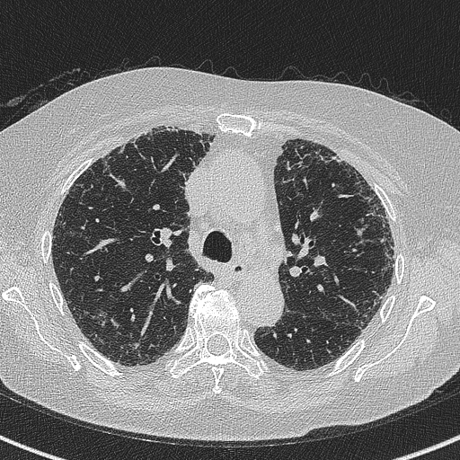 Amiodarone-induced pulmonary fibrosis (Radiopaedia 82355-96460 Axial lung window 25).jpg