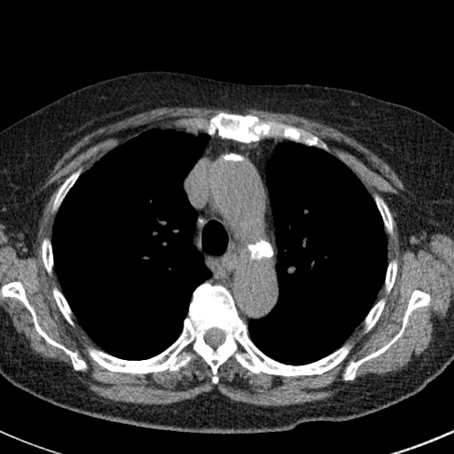 File:Amiodarone-induced pulmonary fibrosis (Radiopaedia 82355-96460 Axial non-contrast 23).jpg