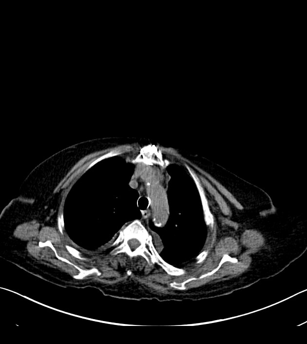 Amiodarone deposition in the liver (Radiopaedia 77587-89780 Axial non-contrast 20).jpg