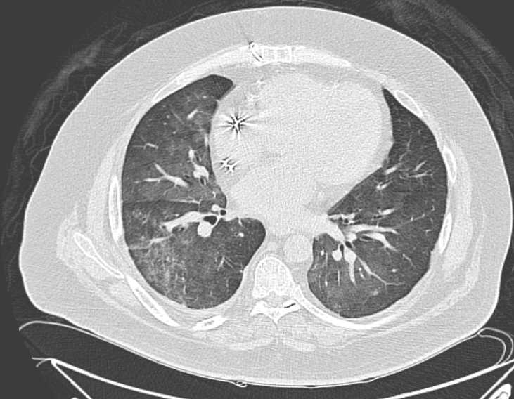 Amiodarone lung (Radiopaedia 62514-70769 Axial lung window 53).jpg