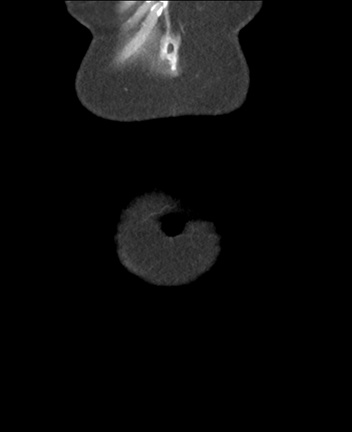 Ampullary adenocarcinoma (Radiopaedia 34013-35237 E 4).png