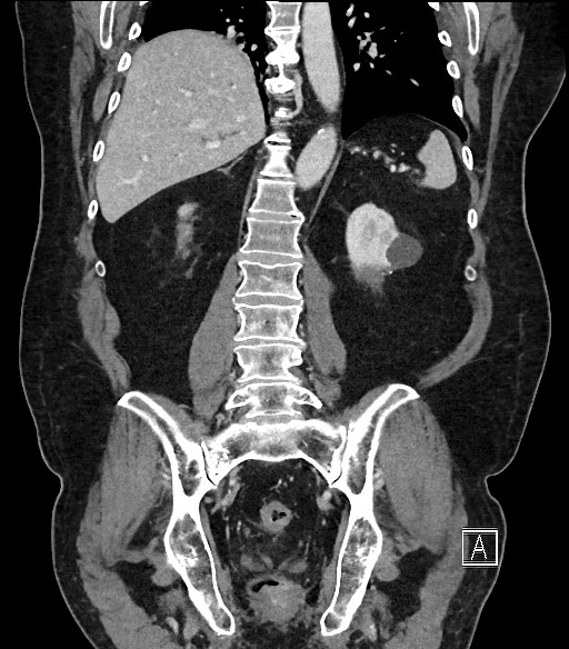 Ampullary adenocarcinoma (Radiopaedia 59373-66734 D 77).jpg
