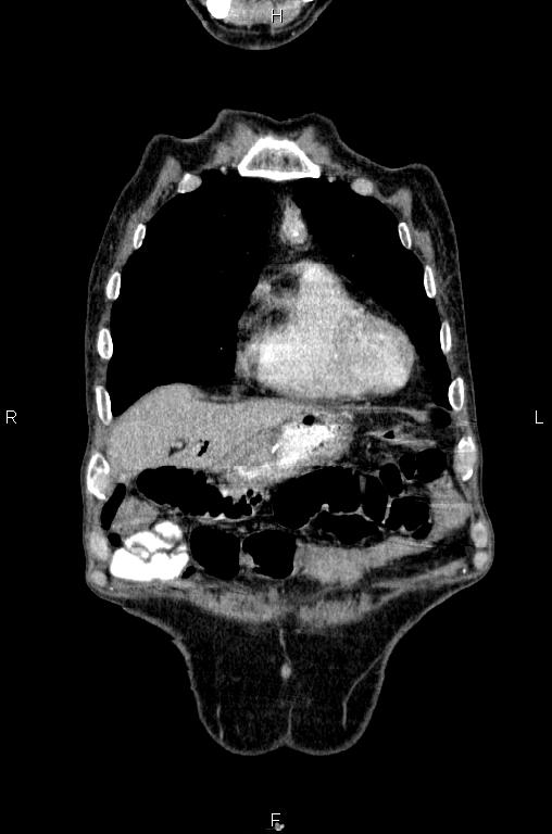 Ampullary adenocarcinoma (Radiopaedia 86093-102033 D 10).jpg
