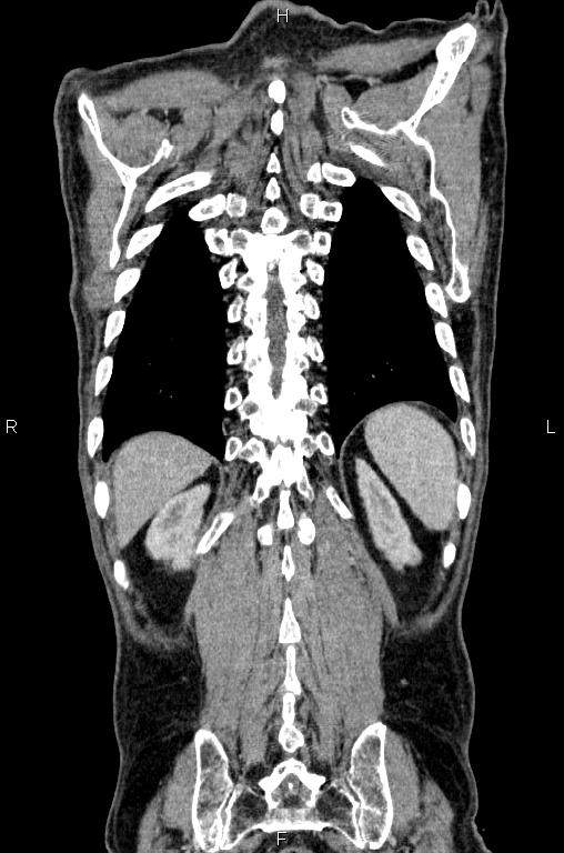 Ampullary adenocarcinoma (Radiopaedia 86093-102033 D 53).jpg
