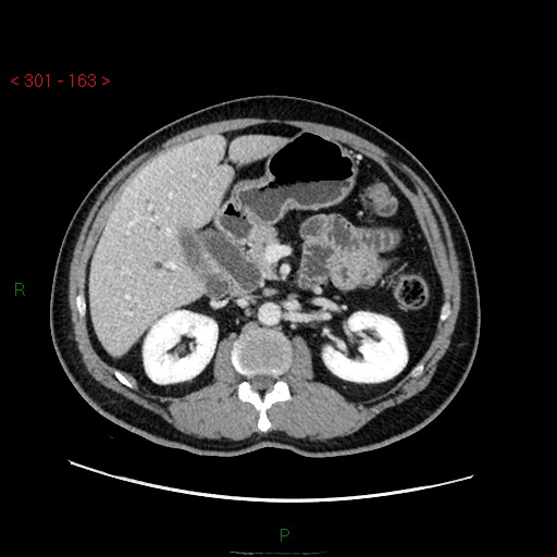 File:Ampullary carcinoma (Radiopaedia 56396-63056 C 36).jpg
