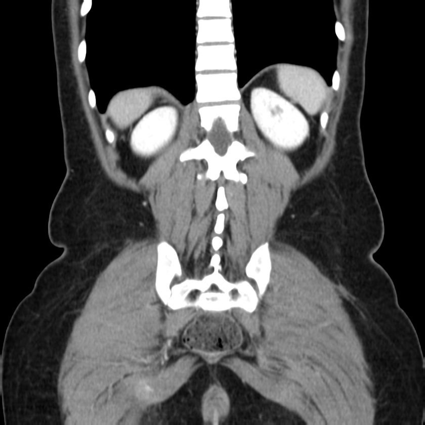 Ampullary tumor (Radiopaedia 22787-22816 E 43).jpg