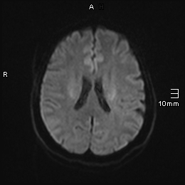 File:Amyotrophic lateral sclerosis (Radiopaedia 70821-81017 Axial DWI 9).jpg