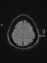 Amyotrophic lateral sclerosis (Radiopaedia 70821-81017 Axial SWI 52).jpg
