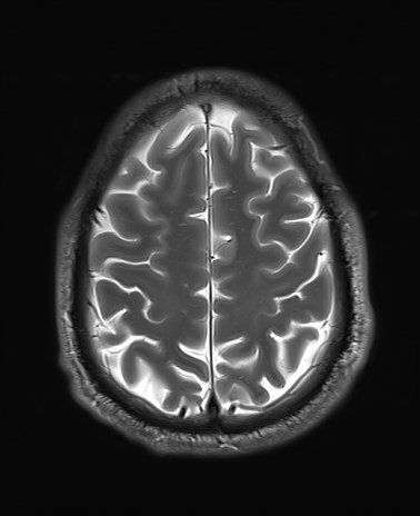 File:Amyotrophic lateral sclerosis (Radiopaedia 87352-103658 Axial T2 24).jpg