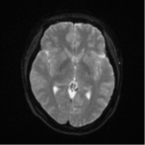 Anaplastic astroblastoma (Radiopaedia 55666-62194 Axial DWI 14).png