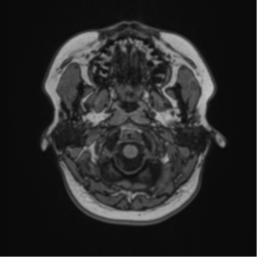 Anaplastic astroblastoma (Radiopaedia 55666-62194 Axial T1 5).png